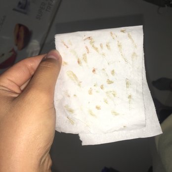 Beauty Legend - Yes ladies and gentlemen, this is all my dirt, sweat, clogged pores, pimples, etc. KK extracted all of this from my face !!! - Skin Care Near Me - Oakland, California Beauty Legend - Yes ladies and gentlemen, this is all my dirt, sweat, clogged pores, pimples, etc. KK extracted all of this from my face !!! - Skin Care Near Me - Oakland, California