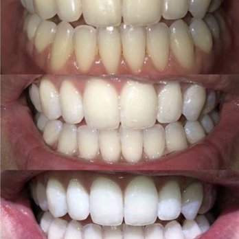 Teeth Whitening Spa - Teeth Whitening Near Me - Williamsville, New York Teeth Whitening Spa - Teeth Whitening Near Me - Williamsville, New York