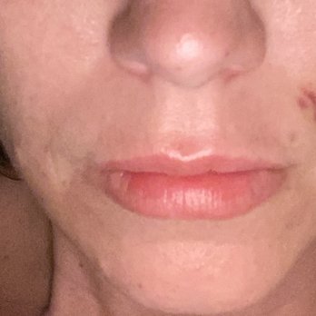 Victory MedSpa - Mishap / injury during procedure - Medical Spas Near Me - Austin, Texas