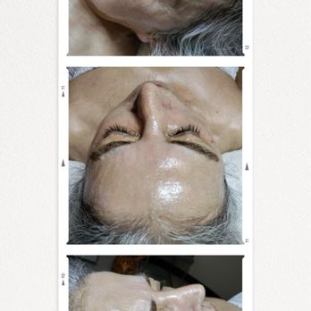 Goldcoast Medspa - Post Facial Glow - Medical Spas Near Me - Chicago, Illinois Goldcoast Medspa - Post Facial Glow - Medical Spas Near Me - Chicago, Illinois