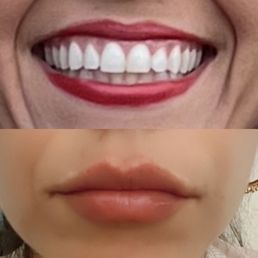 Lip fillers Lip fillers