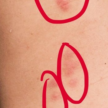 Quality Inn & Suites - Bite marks from bedbugs - Hotels Near Me - Sault Ste. Marie, Ontario Quality Inn & Suites - Bite marks from bedbugs - Hotels Near Me - Sault Ste. Marie, Ontario