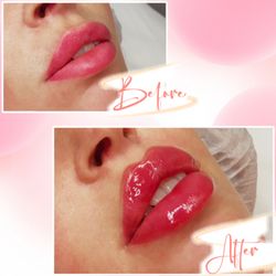 Hush Aesthetics - Lip filler before and after