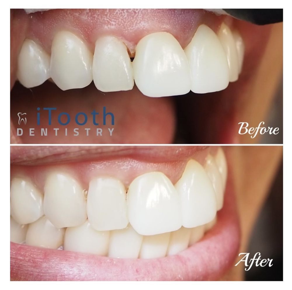 ITOOTH DENTISTRY 118 Photos & 61 Reviews 7035 N Chestnut Ave