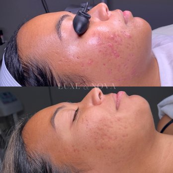 Luxe & Nova - Acne Clear Skin Program - 4 month progress - Skin Care Near Me - Waipahu, Hawaii Luxe & Nova - Acne Clear Skin Program - 4 month progress - Skin Care Near Me - Waipahu, Hawaii