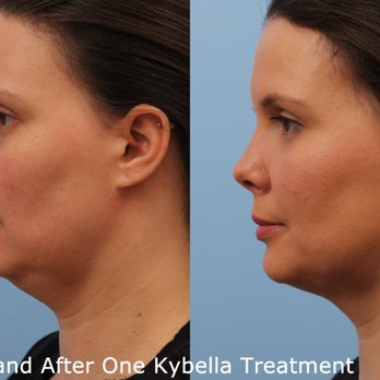 Cosmetic Dermatology Center - Patient having more submental definition after a Kybella treatment - Dermatologists Near Me - McLean, Virginia Cosmetic Dermatology Center - Patient having more submental definition after a Kybella treatment - Dermatologists Near Me - McLean, Virginia