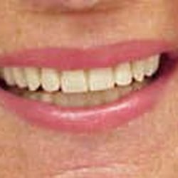 Free Implants NOW - FreeImplantsNOW.com