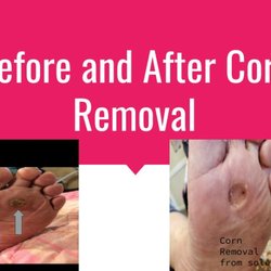 Southern California Foot and Ankle Center - Corn Removal