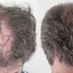 Rahal Hair Transplant - Discover more amazing before & after photos here, http://www.rahalhairtransplant.com/rahal-results/hair-transplant-before-and-af