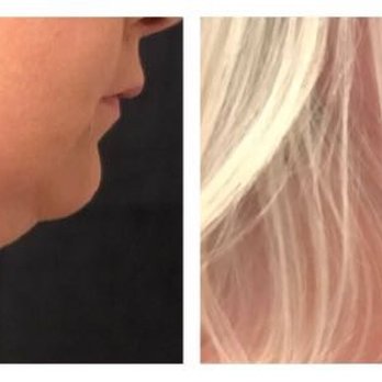 Advanced Skin and Body Solutions - Initial photo, before first cycle then after 30 days - Medical Spas Near Me - Bellevue, Washington