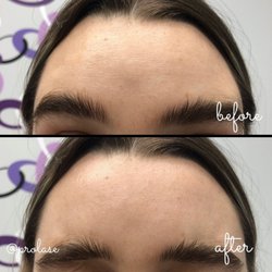 Prolase Laser Clinic - Botox injectable - forehead lines.
