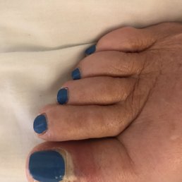 Infection after pedicure at Cyndi Nails.