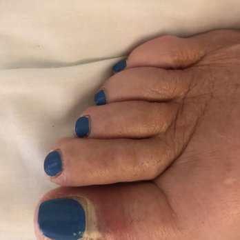 Cyndi Nails - Infection after pedicure at Cyndi Nails. - Nail Salons Near Me - Elmhurst, Illinois