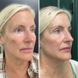 DermFx