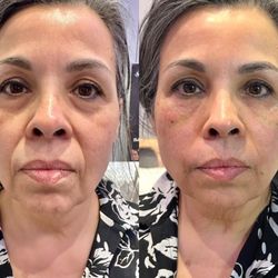 Regenerative Medical Clinics of SoCal - PRP Facial: using your own plasma to boost collagen, smooth fine lines, and reveal fresher, glowing skin -- naturally.