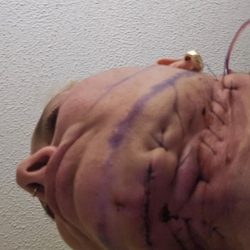 Lloyd D Landsman MD - Reconstruction Surgery from a Botched Chin Lipo