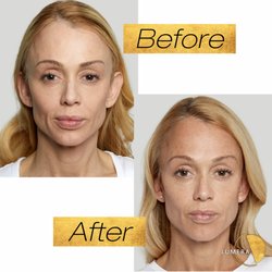 Lumera Regenerative Medicine - Sculptra treatment before and after results.