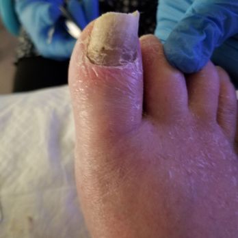 Rainier Rehabilitation - My dads toe nail fungus left untreated - Rehabilitation Center Near Me - Puyallup, Washington Rainier Rehabilitation - My dads toe nail fungus left untreated - Rehabilitation Center Near Me - Puyallup, Washington