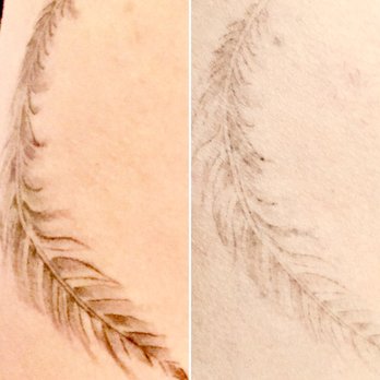 No Regrets Laser Tattoo Removal - Some tattoos respond so quickly to treatment, like this torso feather tattoo! - Tattoo Removal Near Me - Marrickville, NSW No Regrets Laser Tattoo Removal - Some tattoos respond so quickly to treatment, like this torso feather tattoo! - Tattoo Removal Near Me - Marrickville, NSW