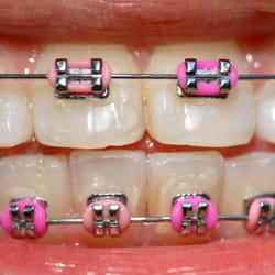 Dental World Panmure - Brace are affordable... Call us today and ask us how