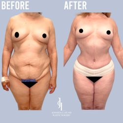 Johnson C. Lee, MD - Mommy Makeover - Tummy Tuck with Brazilian Butt Lift