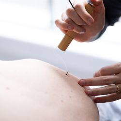 Dancing Aspen Healing Arts - Moxibustion