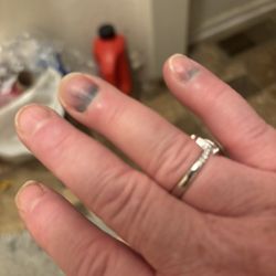 Pictures of my fingers that got smashed in the woman's bathroom door.
