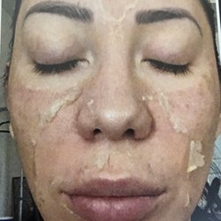 Organic Facial Experience Medical Day Spa - The Perfect Derma Peel is a Medical Grade Chemical Peel for new rejuvenate skin.