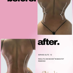 Atlanta Body Sculpt
