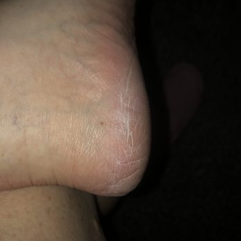 Soho Nail Bar - Dry and scaly only ONE day after pedicure!!! SMH - Nail Salons Near Me - Houston, Texas Soho Nail Bar - Dry and scaly only ONE day after pedicure!!! SMH - Nail Salons Near Me - Houston, Texas
