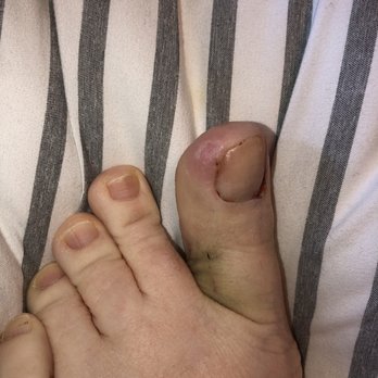 Best Foot Forward - Blister, swollen discolored toe. The very obvious reason I was in the office. Bruising from numbing shot - Podiatrists Near Me - Festus, Missouri