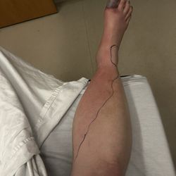 ABC Nails - The line shows how far the infection went up his leg, less than 48 hours after receiving a pedicure at ABC Nails