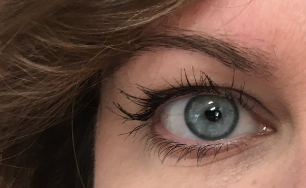 reddit apostrophe acne