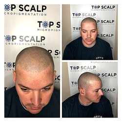 Top Scalp Micro - Expert follicle replication with SMP