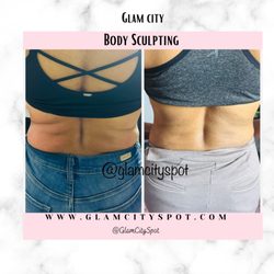Glam City - Love handles reduce with non surgical body sculpting