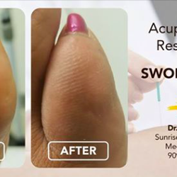 Sunrise Acupuncture Medical Center - Results after 4 treatments for swollen toe, This patient was ecstatic about being able to walk and wear her everyday shoes again.