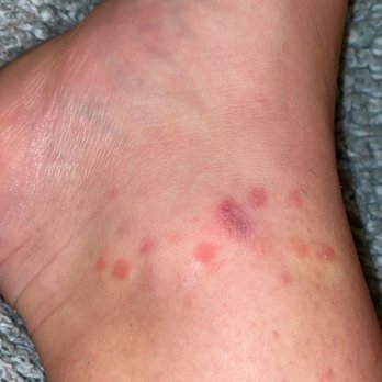 The Redland Apartments - FLEA BITES LESS THAN A WEEK LIVING THERE - Apartments Near Me - Athens, Georgia The Redland Apartments - FLEA BITES LESS THAN A WEEK LIVING THERE - Apartments Near Me - Athens, Georgia