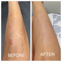 Dermatology Partners of Western Ny Llp - 10 years of eczema, cleared in 4 weeks!