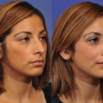 Jesse E Smith, MD, FACS - Rhinoplasty Before & After #6 - Plastic Surgeons Near Me - Fort Worth, Texas Jesse E Smith, MD, FACS - Rhinoplasty Before & After #6 - Plastic Surgeons Near Me - Fort Worth, Texas