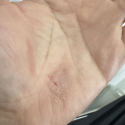 Quan Nguyen, MD - Q-Dermatology - Itchy & redness continues. Same issue, not resolving yet