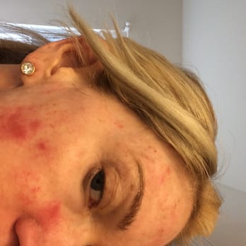 Regenesis Skin Studio - VI Peel with Terri.   Burns all over the one side of my face. - Medical Spas Near Me - Indian Trail, North Carolina
