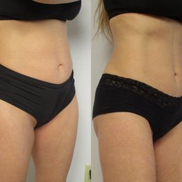 Before and after Emsculpt, Dr Persky, Encino, Californina. Before and after Emsculpt, Dr Persky, Encino, Californina.