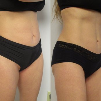 Michael A. Persky, M.D, F.A.C.S - Before and after Emsculpt, Dr Persky, Encino, Californina. - Cosmetic Surgeons Near Me - Encino, California Michael A. Persky, M.D, F.A.C.S - Before and after Emsculpt, Dr Persky, Encino, Californina. - Cosmetic Surgeons Near Me - Encino, California