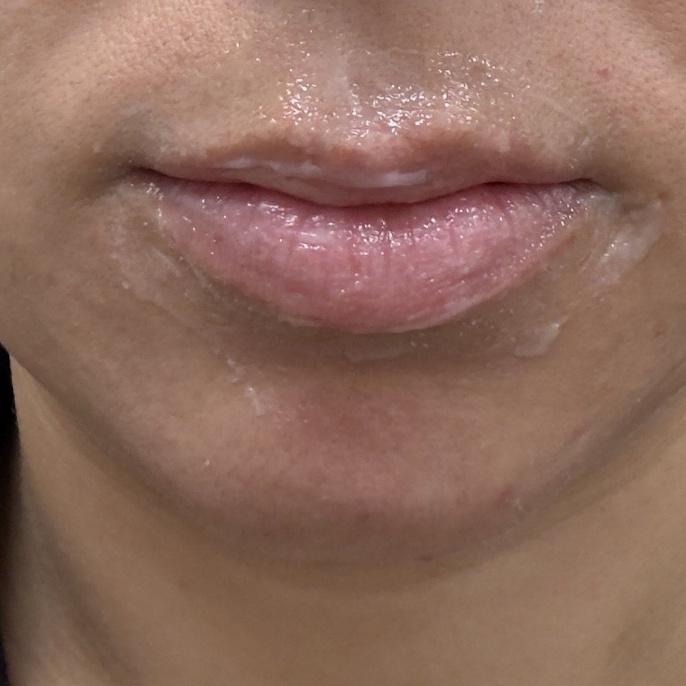 Before pic with numbing cream on lips. Top lip has weird shape and thin. Before pic with numbing cream on lips. Top lip has weird shape and thin.