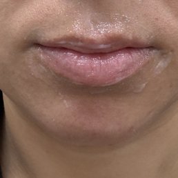 Before pic with numbing cream on lips. Top lip has weird shape and thin.