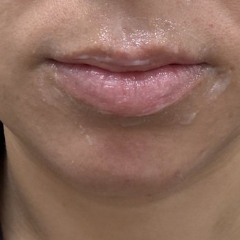 NAKEDMD - Chula Vista - Before pic with numbing cream on lips. Top lip has weird shape and thin. - Medical Spas Near Me - Chula Vista, California