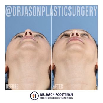Jason Roostaeian, MD - Even nostrils - Cosmetic Surgeons Near Me - Los Angeles, California Jason Roostaeian, MD - Even nostrils - Cosmetic Surgeons Near Me - Los Angeles, California