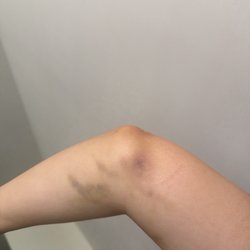 Labcorp - A week after getting her blood drawn (just keeps spreading and getting worse)