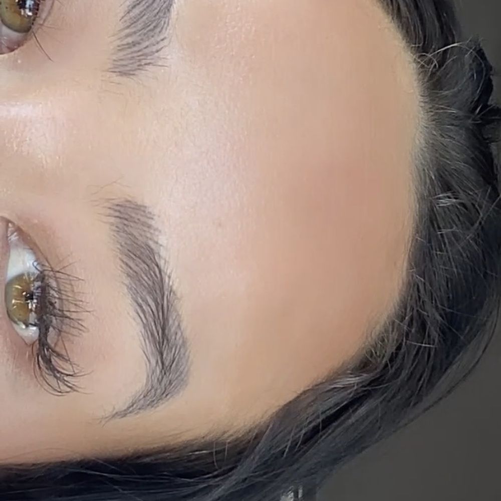 Almost 1 year healed. I have foundation on around my eyebrows, NO PENCIL USED