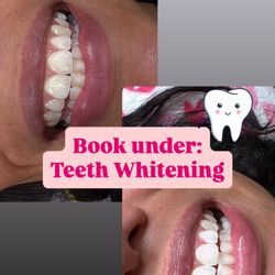 ilashyou_lv - Before and After Teeth Whitening